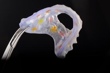 Custom 3D Printed Lingual Appliance