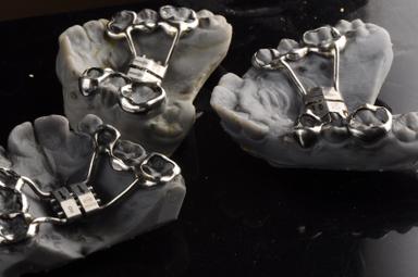 Palatal Expander