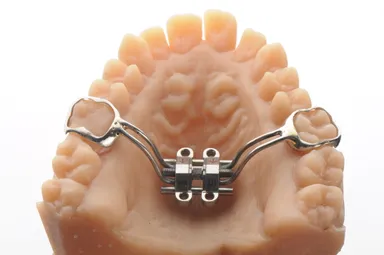 Miniscrew Assisted Rapid Palatal Expander (MARPE)