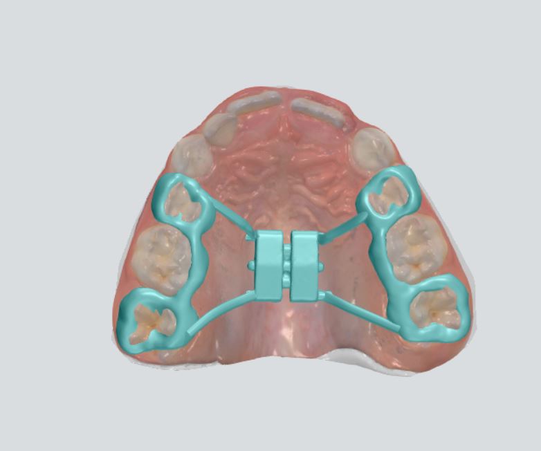palatal expander