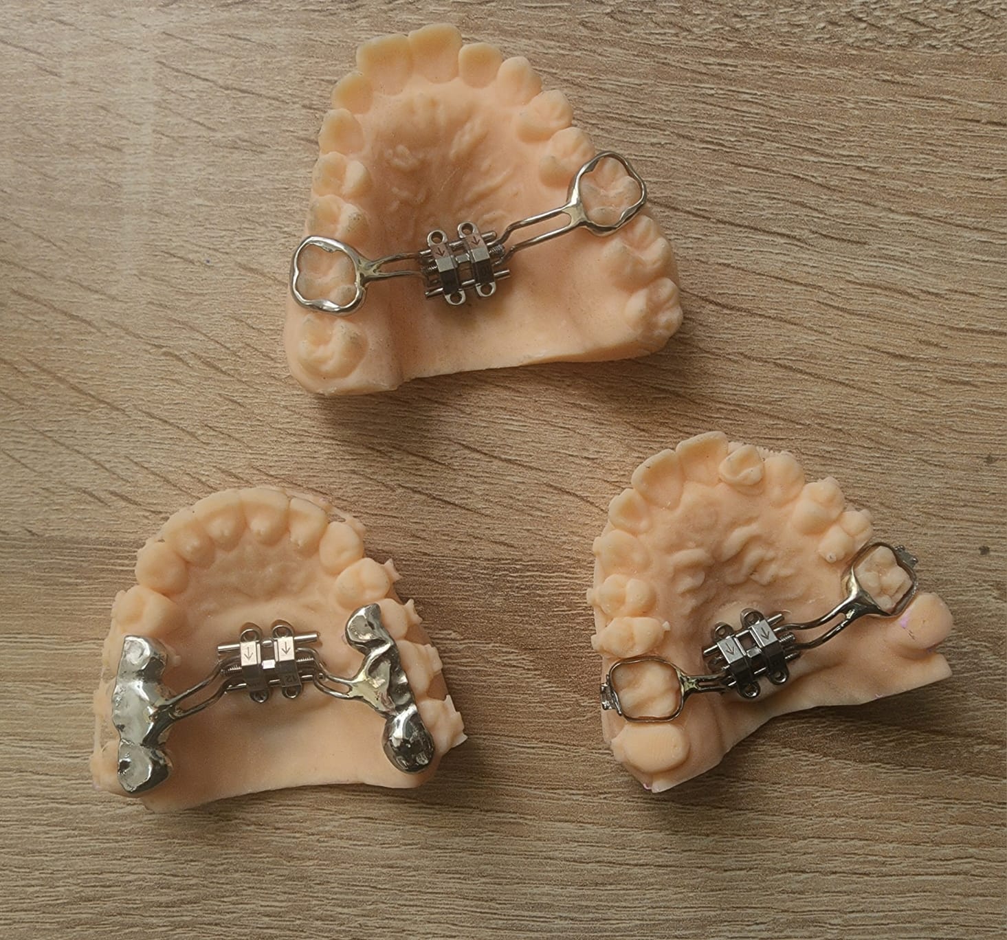 palatal expander