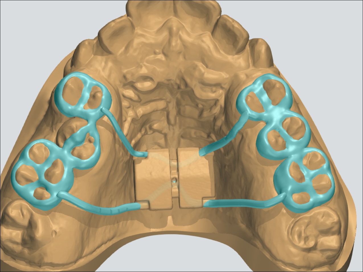 palatal expander