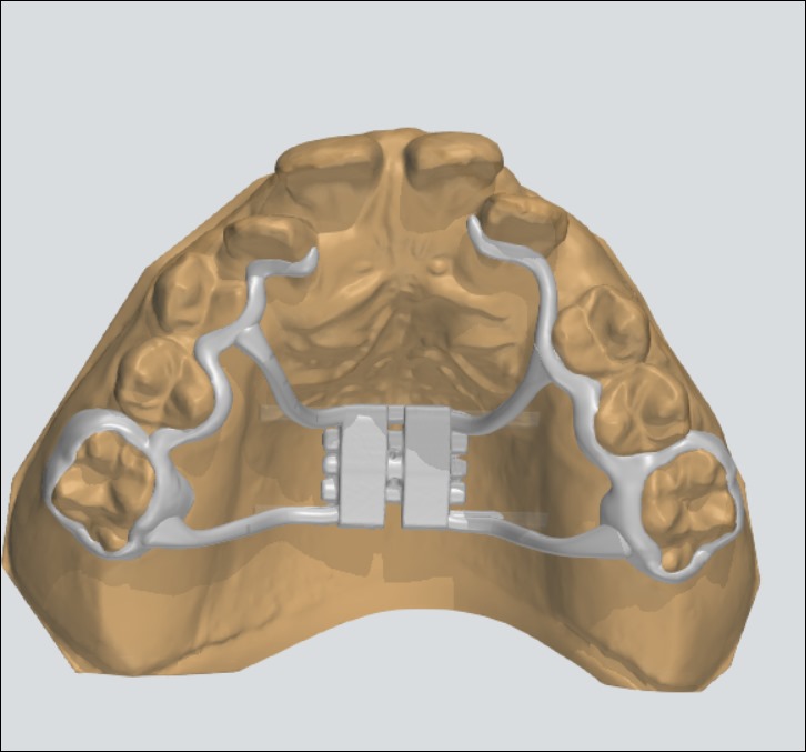 palatal expander