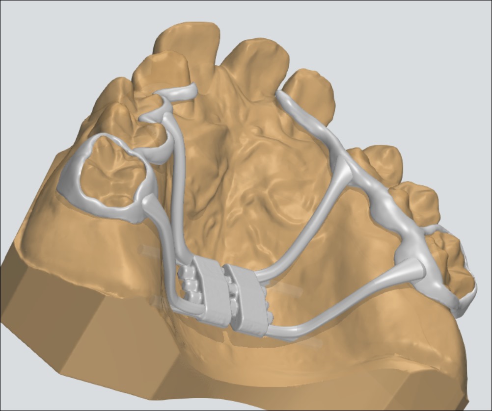 palatal expander
