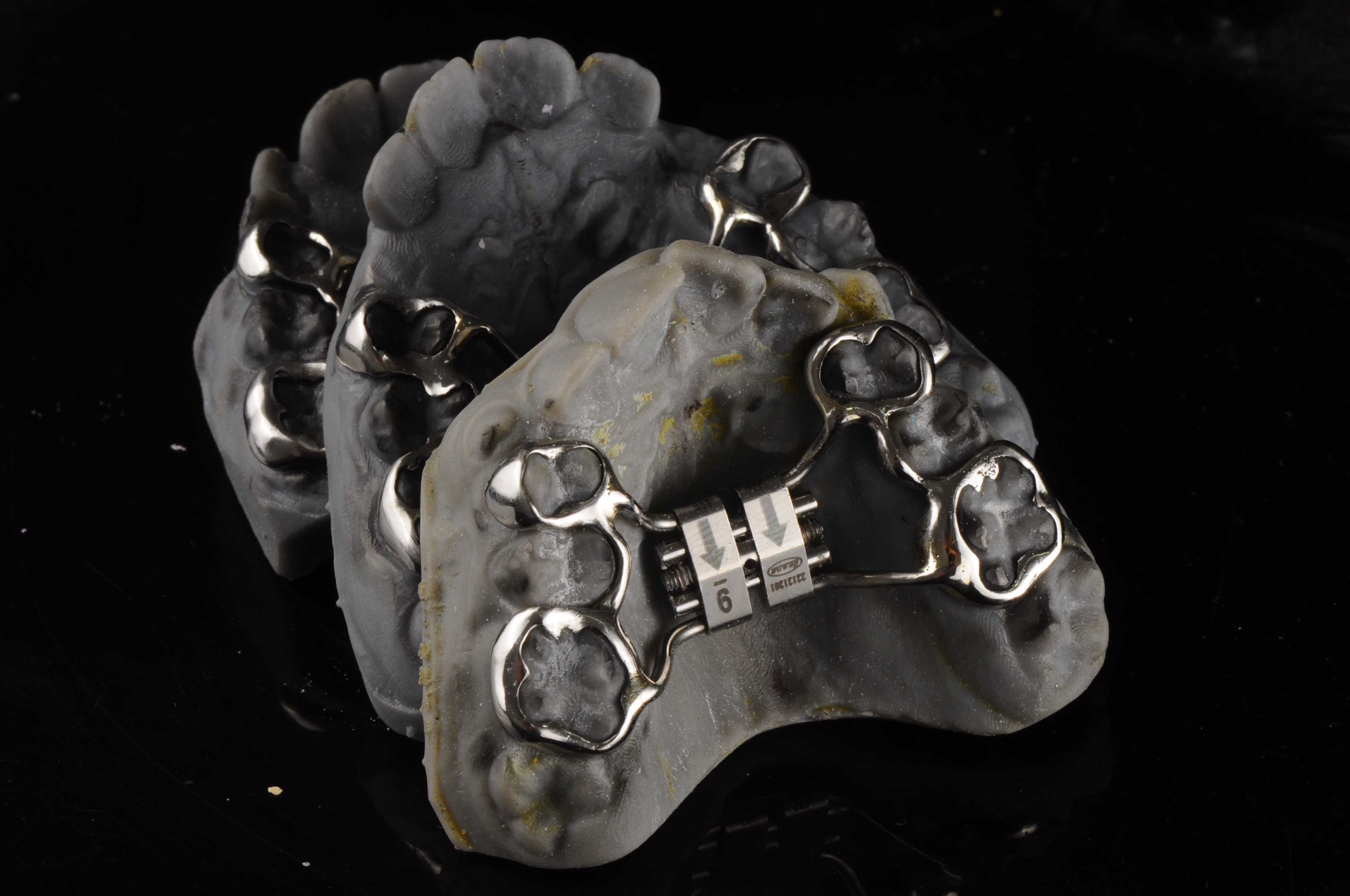 palatal expander